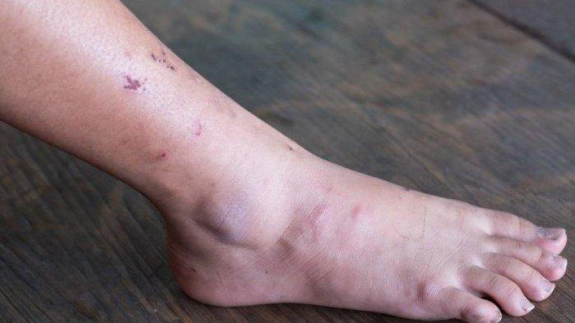 Bekas Luka di Kaki Jadi Hitam dan Bikin Nggak Pede? Coba Atasi dengan 10 Bahan Alami Ini