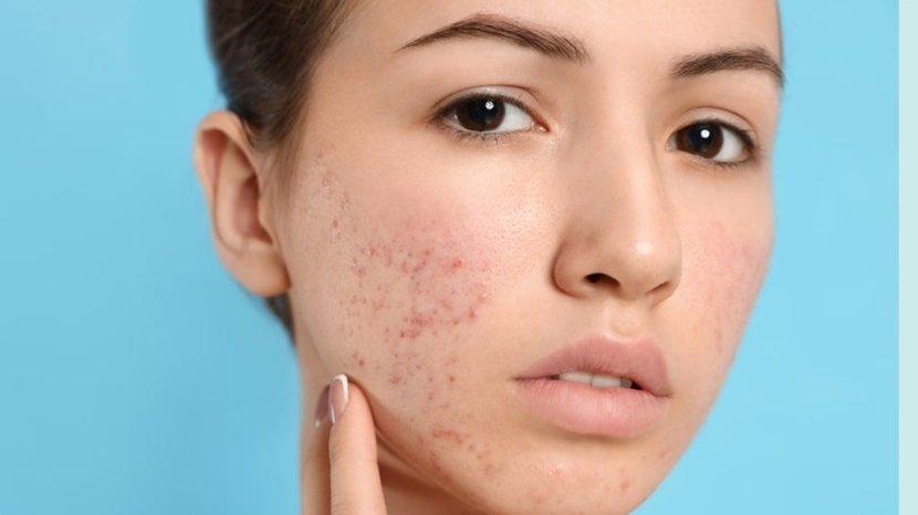 5 Bahan Alami yang Ampuh Menyamarkan Noda Bekas Jerawat di Wajah