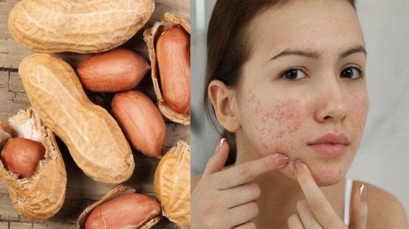 Benarkah Kacang Dapat Memicu Timbulnya Jerawat? Ini Penjelasannya
