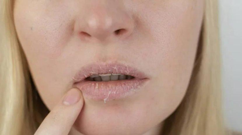 Penyebab dan Cara Mengatasi Bibir Kering Disertai Pecah-pecah dengan Bahan Alami
