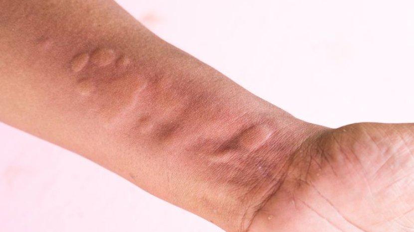 Sering Biduran saat Musim Pancaroba? Atasi dengan 7 Obat Alami Ini