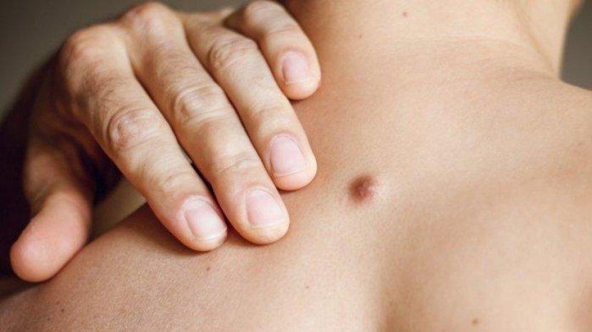 Hindari Mulai Sekarang, 4 Makanan Ini Penyebab Munculnya Bisul Pada Kulit