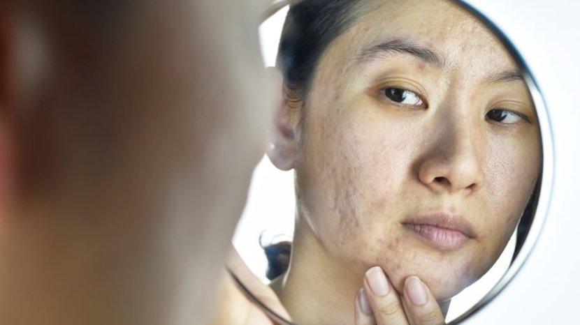 Tak Pede karena Wajahmu Bopeng? Ini 9 Tips Mengatasi Tekstur Kulit Tidak Merata