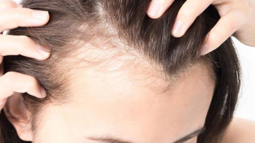 5 Bahan Alami untuk Mengatasi Kebotakan Rambut Sebagian, Murah dan Mudah Didapat
