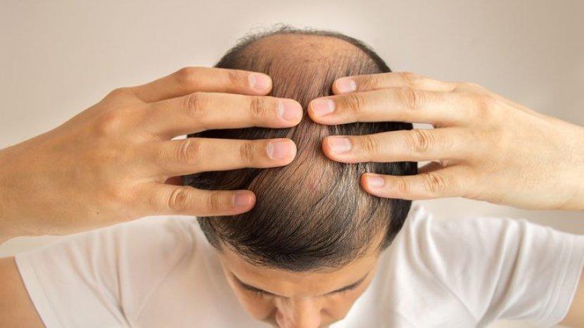 Rambut Lansia Mudah Rontok Perhatikan Rangkaian Perawatan dengan Tepat
