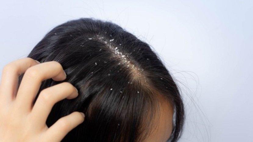 Bye-bye Rambut Berketombe dengan 5 Bahan Herbal Ini, Kulit Kepala Lebih Sehat