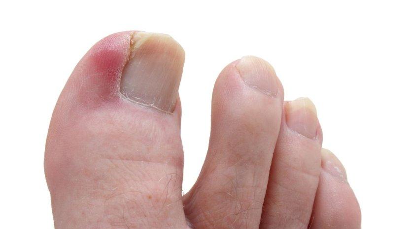 7 Cara Alami Mengatasi Jempol Kaki Cantengan, Bahannya Mudah Ditemukan