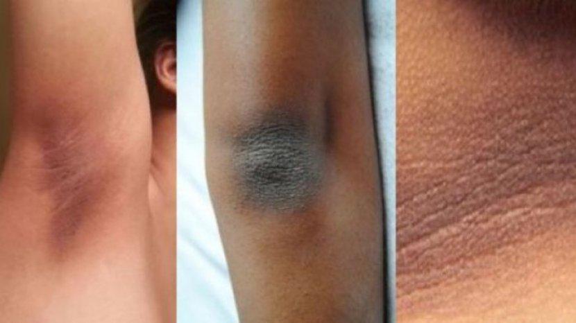 Hal yang Perlu Diperhatikan Sebelum Melakukan Perawatan Badan Menggunakan Batu