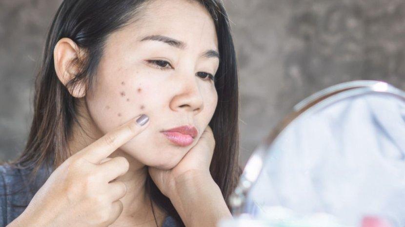 5 Bahan Alami Paling Mudah Ditemukan untuk Mengatasi Masalah Jerawat di Wajah