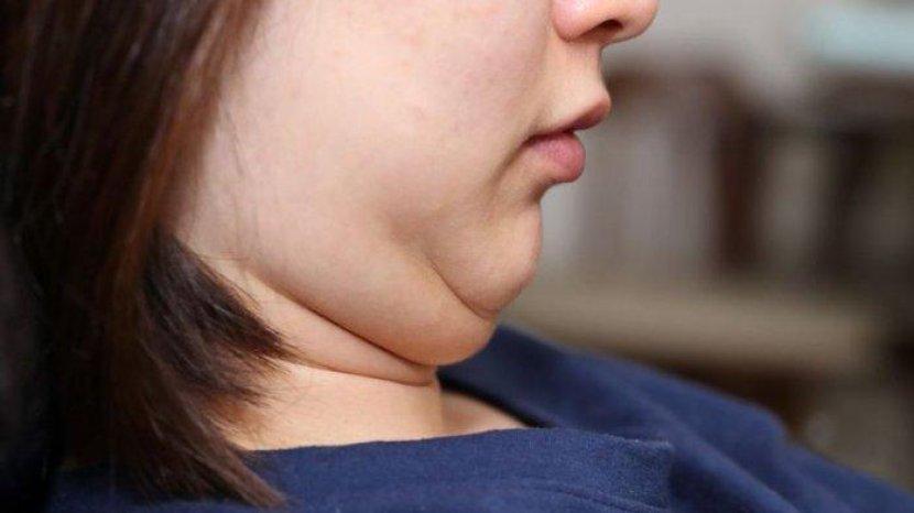 Double Chin Mengganggu Penampilanmu? Ini 7 Cara Mengatasinya tanpa Operasi