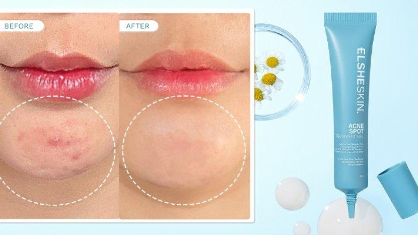 elsheskin-acne-spot-treatment-gel-3.jpg