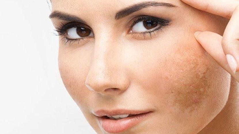 Selain karena Usia, Ini 7 Penyebab Flek Hitam Muncul di Wajahmu