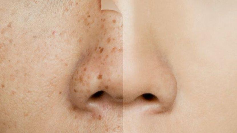 5 Cara Ampuh Mengatasi Flek Hitam Pakai Bahan Alami yang Murah dan Mudah Didapat