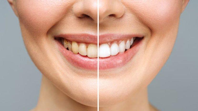 Tak Perlu Bleaching dan Veneer, 8 Cara Alami Ini juga Ampuh Bikin Gigi Kuning jadi Putih