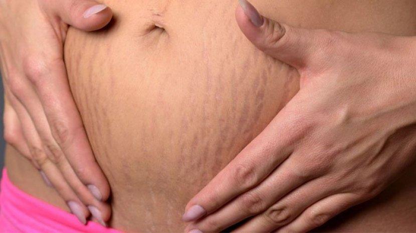 7 Bahan Alami yang Ampuh Mengatasi Stretch Mark, Dapatkan Hasil Terbaik dengan Penggunaan Rutin