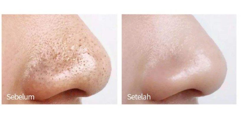 hasil-penggunaan-masker-hempas-komedo-kualitas-terbaik.jpg