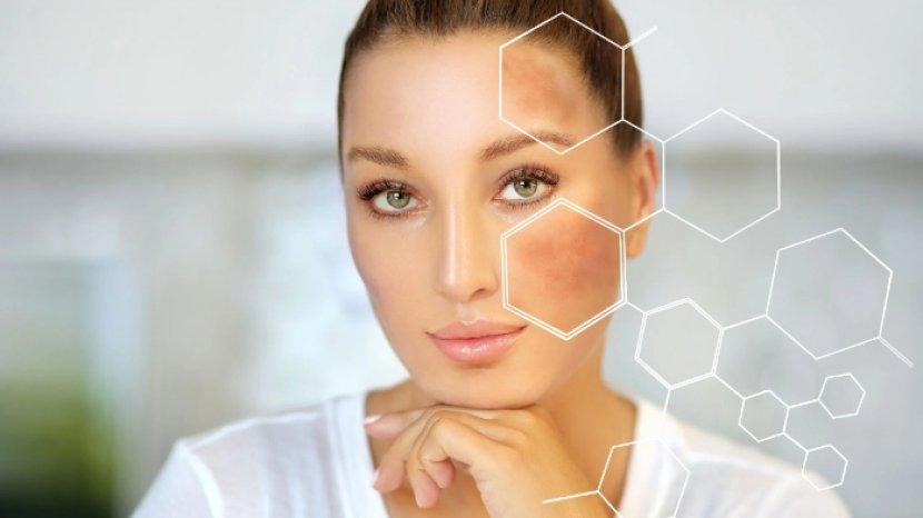 5 Rekomendasi Serum Wajah untuk Mengatasi Melasma, Warna Kulit Dijamin Cerah Merata Kembali