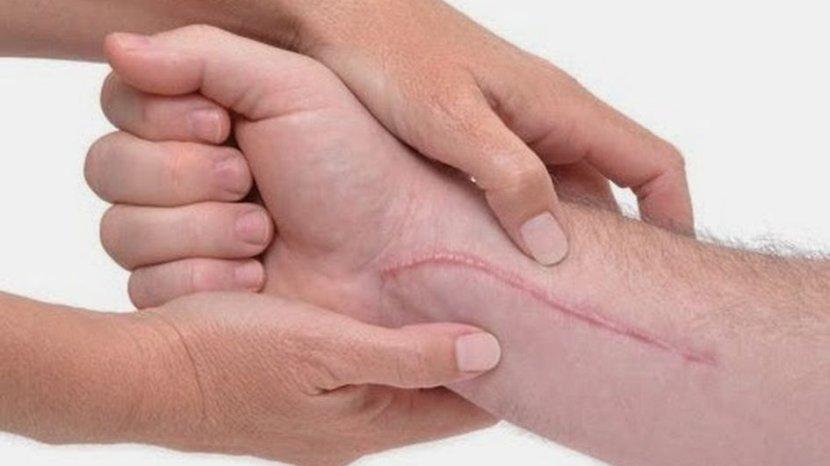 Keloid Ternyata Bisa Diatasi dengan 6 Bahan Alami Ini, Salah Satunya Bawang Putih