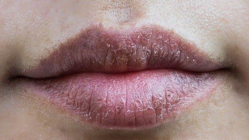 Bibir Hitam Bisa Merona Kembali Cuma Pakai 7 Bahan Alami Ini
