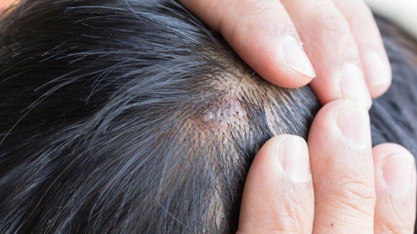 7 Cara Mengobati Jerawat di Kulit Kepala, Berhati-hatilah saat Pilih Produk Perawatan Rambut