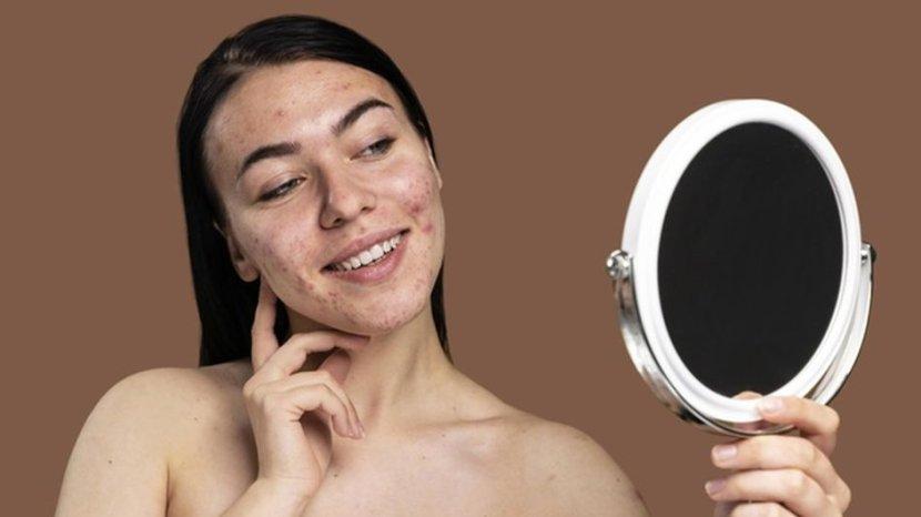 5 Produk SK-II untuk Bantu Kurangi Jerawat di Kulit Wajah