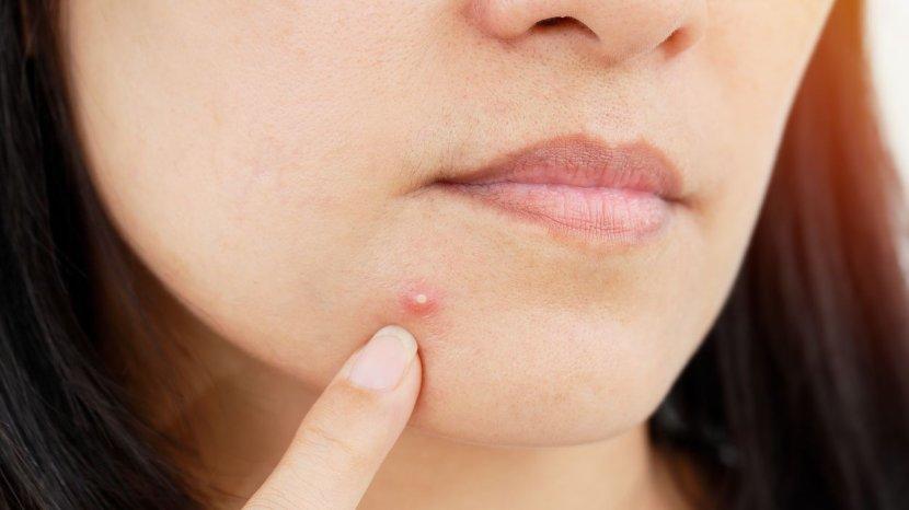 7 Cara Hempas Jerawat di Dagu, Segera Atasi agar Tak Iritasi dan Muncul Lagi