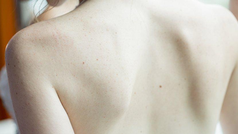 Jerawat di Punggung Bikin Tidak Percaya Diri? Coba Atasi dengan 5 Rekomendasi Sabun Mandi Ini