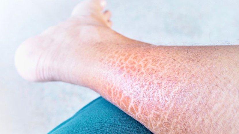 5 Bahan Alami Mengatasi Kaki Kering Bersisik, Kulit Kembali Mulus
