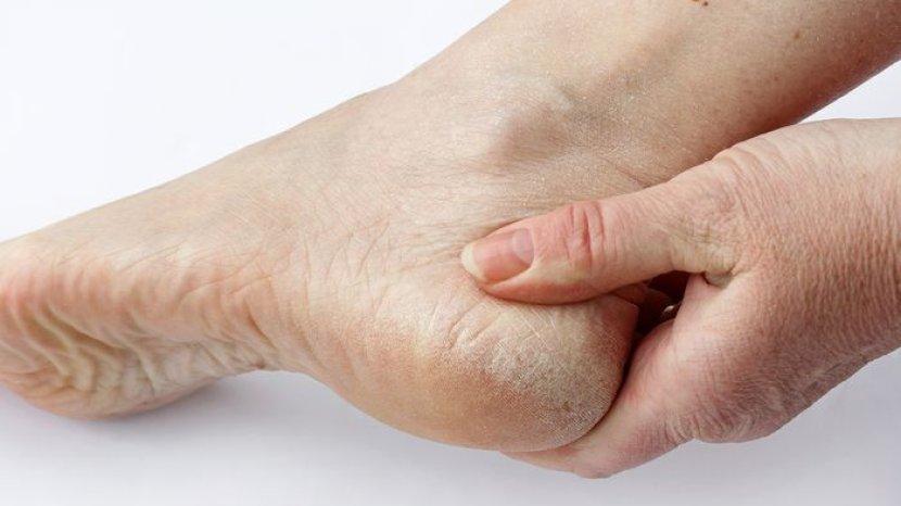 5 Cara Merawat Kulit Kaki Kering agar Tak Lagi Bersisik, Ampuh Bikin Lebih Halus