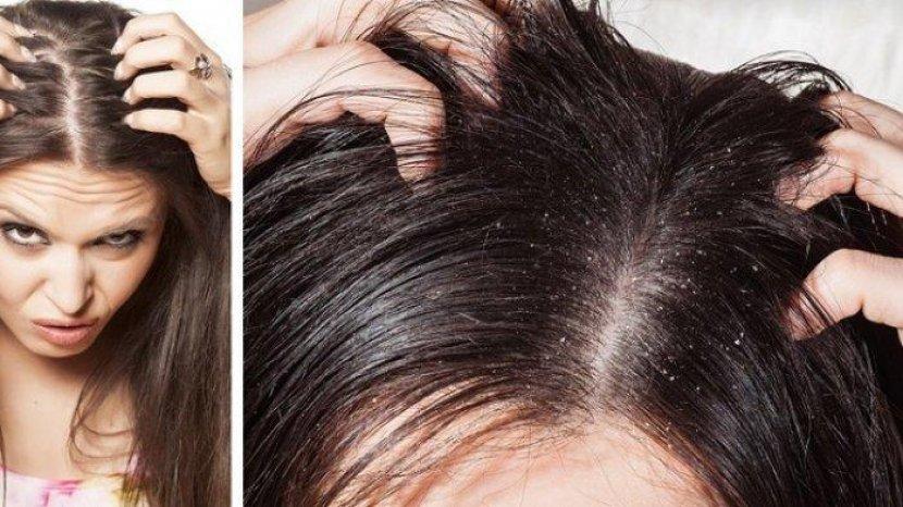 Tips Praktis Hilangkan Gatal pada Rambut, Kepala Sehat Anti Ketombe