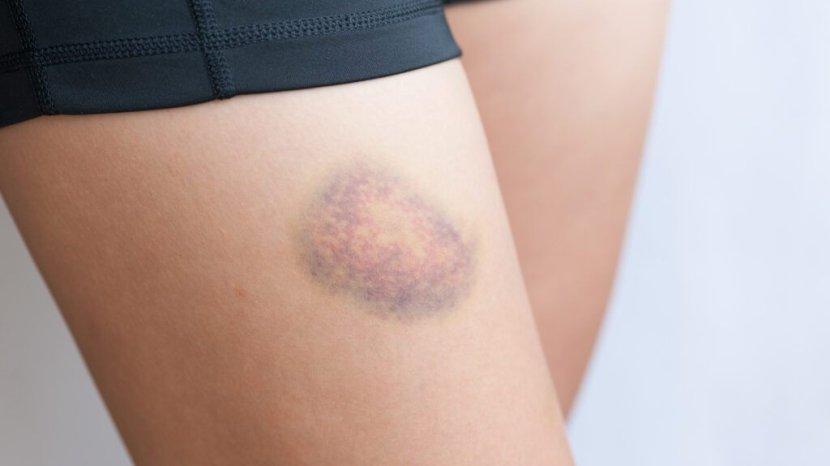 Memar Muncul Tiba-tiba di Kulit Padahal Tidak Terbentur, Mungkin Ini 7 Penyebabnya