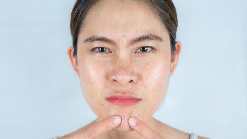 Minyak di Wajah Bikin Kurang Pecaya Diri? Coba Gunakan 5 Produk Klairs Ini