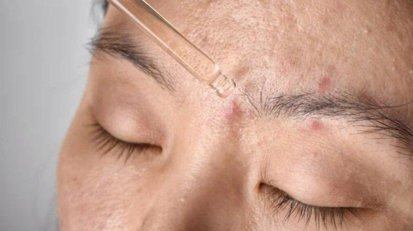 7 Rekomendasi Serum Jerawat Paling Ampuh, Cocok Jadi Pilihan Acne Fighter