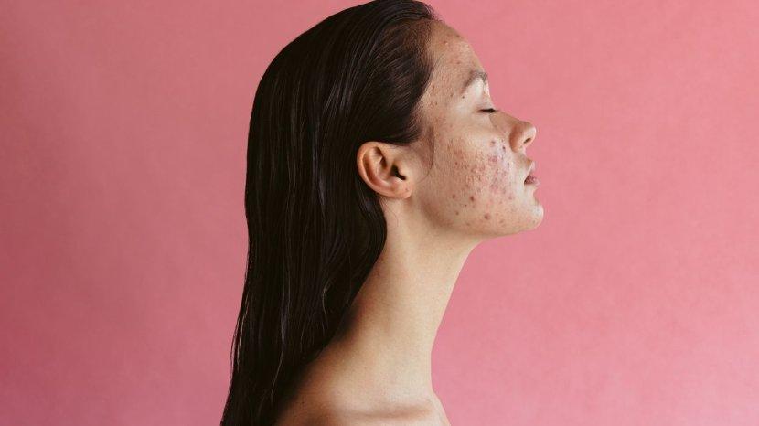 Ampuh! 6 Kandungan Skincare Ini Ahlinya Hempas Jerawat di Wajah