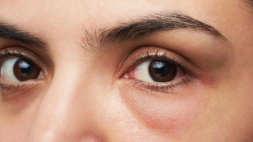 8 Cara Alami Ini Ampuh Mengatasi Kantung Mata tanpa Biaya Mahal