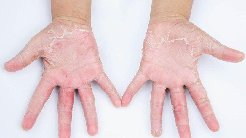 5 Cara Alami untuk Sembuhkan Kulit Kering dan Mengelupas di Musim Kemarau, Semua Bahan Mudah Didapat