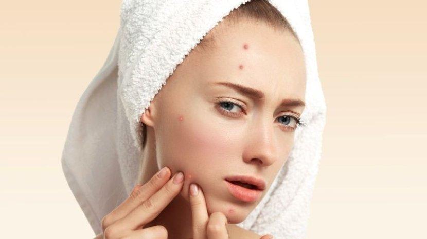 Ampuh Atasi Masalah Jerawat dengan 5 Produk Klairs