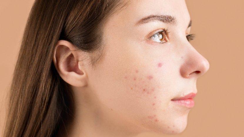 5 Pilihan Acne Spot Care Terbaik yang Mampu Atasi Jerawat di Wajah