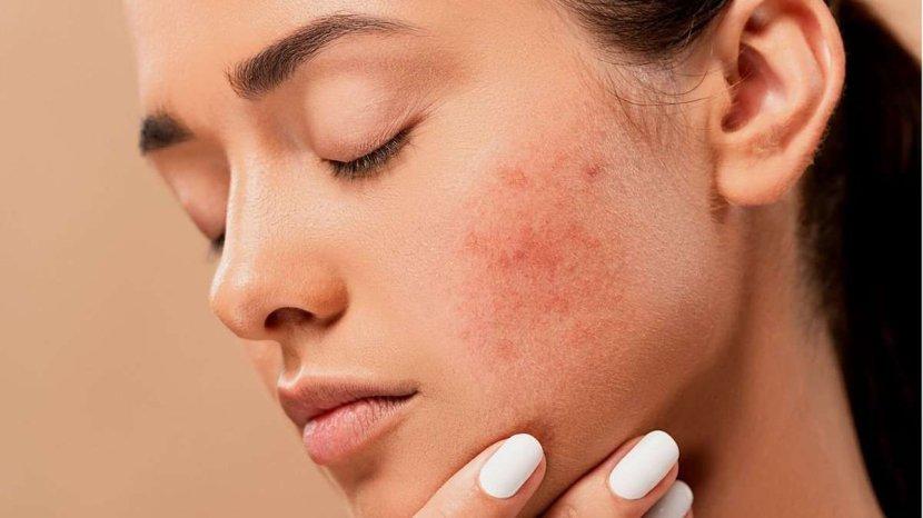 10 Kandungan Skincare yang Aman untuk Kulit Sensitif