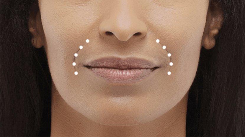 7 Cara Menghilangkan Smile Line atau Garis Senyum yang Membuat Wajah Terlihat Kendur