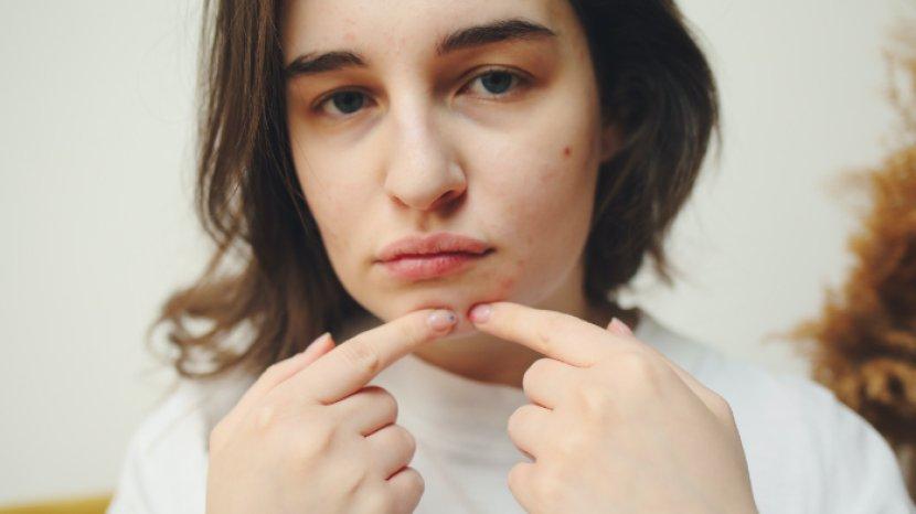 5 Rekomendasi Acne Patch Formula Terbaik yang Efektif Sembuhkan Jerawat Membandel
