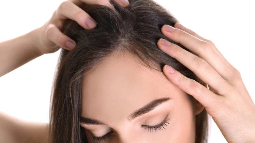 Ketahui Penyebab dan 5 Cara Mengatasi Jerawat yang Muncul di Sekitar Garis Rambut