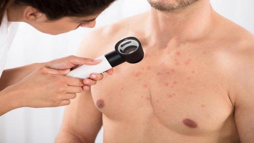 Punya Jerawat di Dada? Begini Cara Benar dan Cepat untuk Menghilangkannya