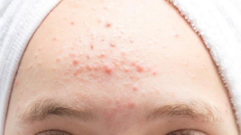 Sociolla Hadirkan Facial Wash untuk Kulit Berminyak dan Berjerawat