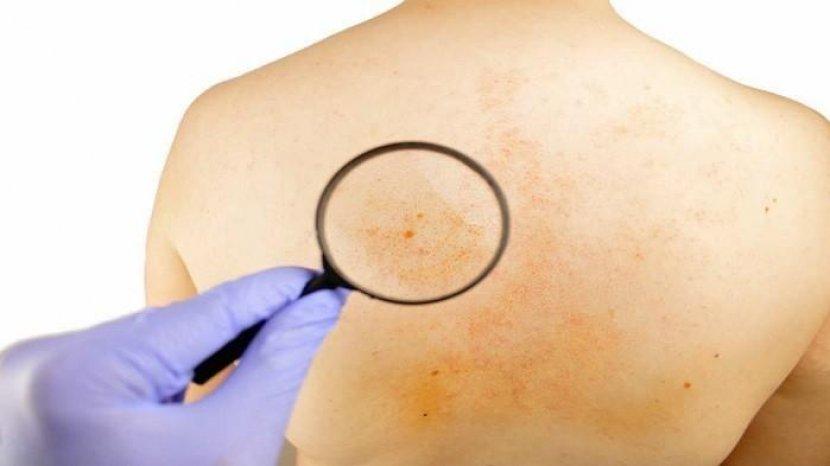 5 Hal Umum yang Jadi Penyebab Jerawat Punggung Tumbuh Subur & Solusi Mengatasinya