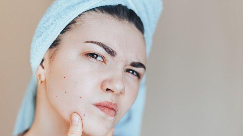 5 Toner Terbaik untuk Atasi Fungal Acne