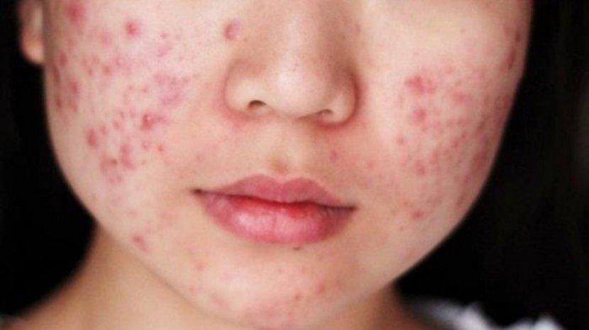 3 Produk Cleansing Bar untuk Mengatasi Jerawat, Kini Tersedia di Sociolla