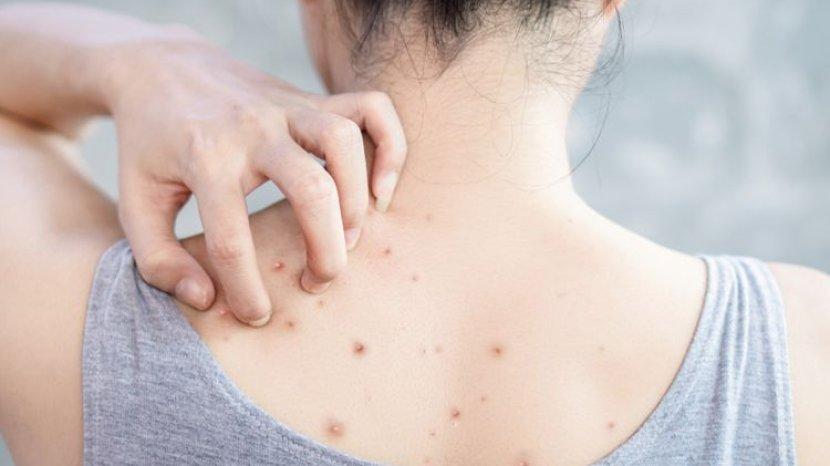 Hempas Jerawat Punggung Mengganggu dengan 5 Rekomendasi Sabun Mandi Khusus