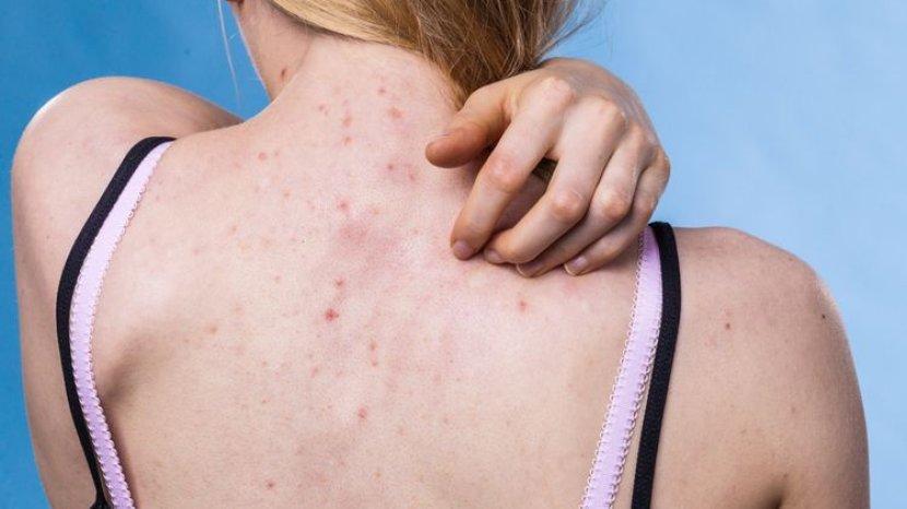 5 Rekomendasi Sabun Mandi Cair untuk Mengatasi Jerawat Punggung