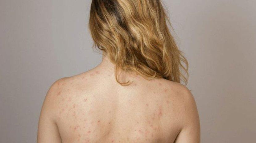 Tuntas Hilangkan Jerawat Punggung dengan ERHA Acne Back Spray